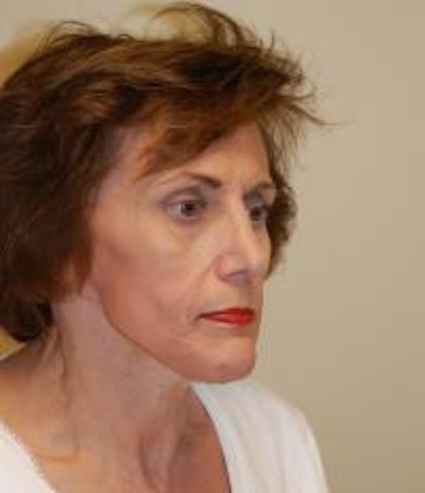 Facelift Before & After Gallery - Patient 22397135 - Image 4