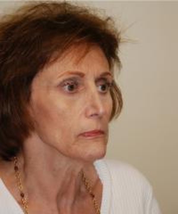 Facelift Before & After Gallery - Patient 22397135 - Image 3