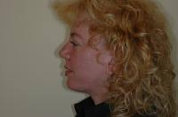 Neck Lift Before & After Gallery - Patient 22397149 - Image 6