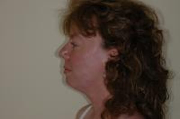 Neck Lift Before & After Gallery - Patient 22397149 - Image 5