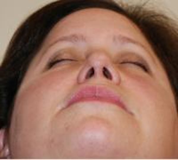 Rhinoplasty Before & After Gallery - Patient 22397163 - Image 5