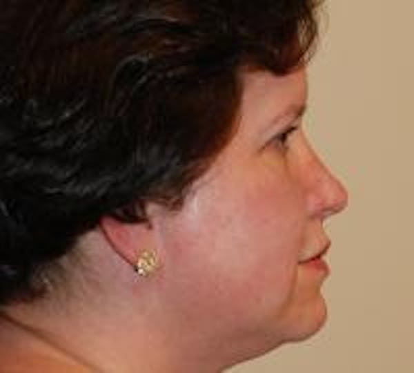 Rhinoplasty Before & After Gallery - Patient 22397163 - Image 7