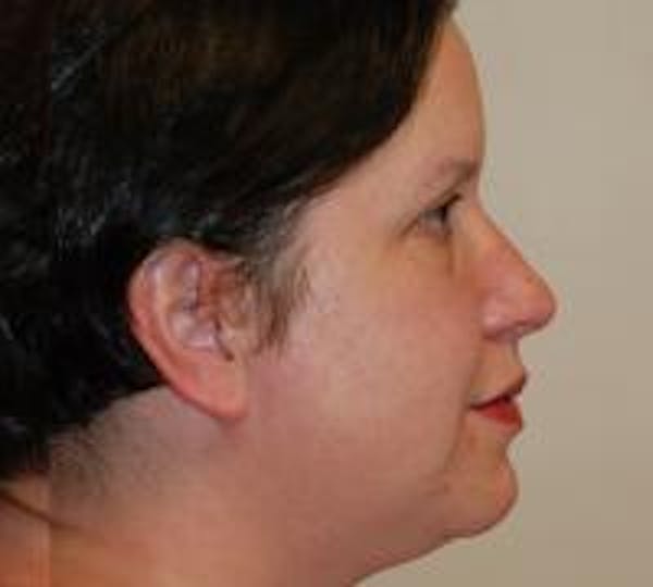 Rhinoplasty Before & After Gallery - Patient 22397163 - Image 8
