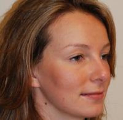 Rhinoplasty Before & After Gallery - Patient 22397164 - Image 4
