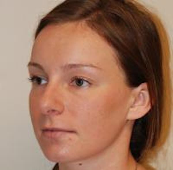 Rhinoplasty Before & After Gallery - Patient 22397164 - Image 5