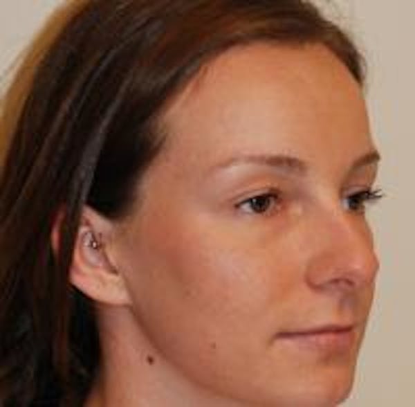 Rhinoplasty Before & After Gallery - Patient 22397164 - Image 3