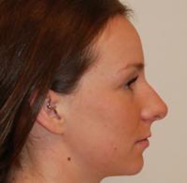 Rhinoplasty Before & After Gallery - Patient 22397164 - Image 7