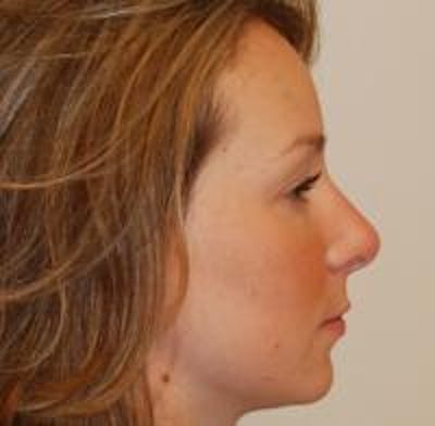 Rhinoplasty Before & After Gallery - Patient 22397164 - Image 8