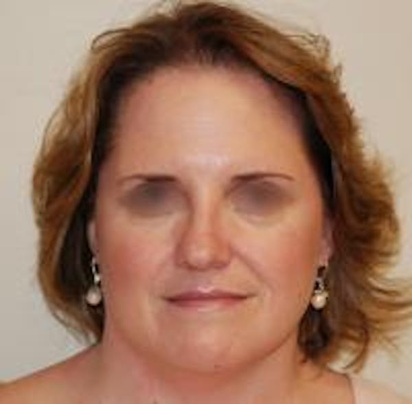Rhinoplasty Before & After Gallery - Patient 22397165 - Image 1