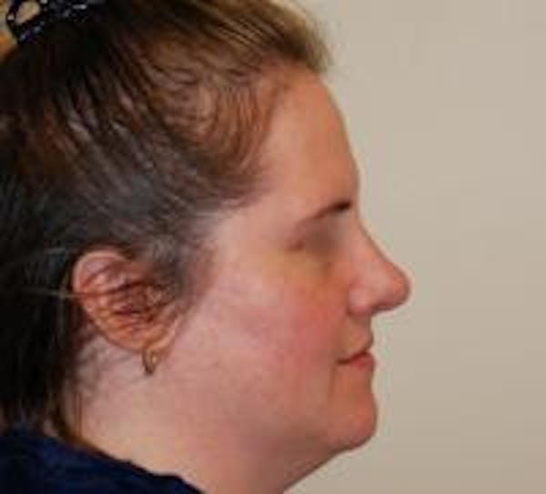 Rhinoplasty Before & After Gallery - Patient 22397165 - Image 4