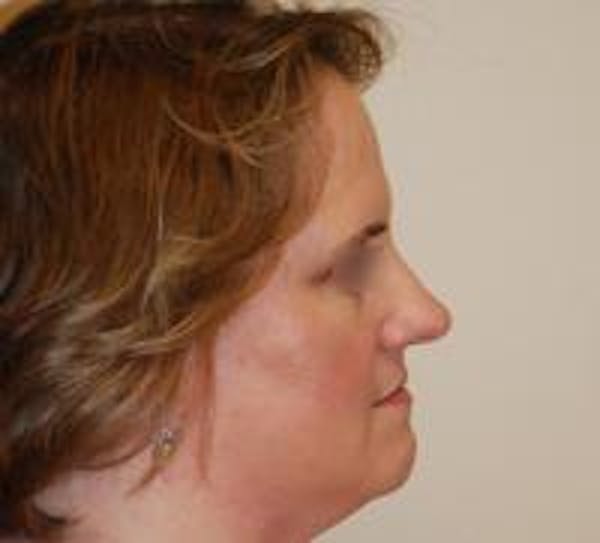 Rhinoplasty Before & After Gallery - Patient 22397165 - Image 3