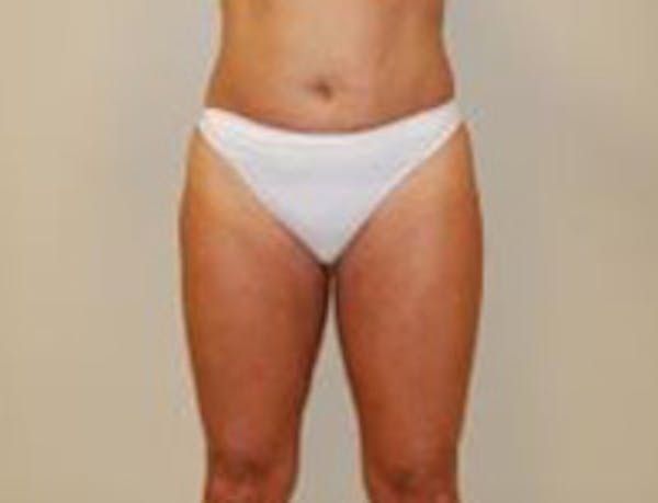 Liposuction Before & After Gallery - Patient 18618245 - Image 2