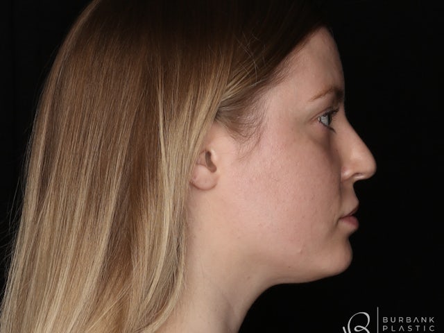 Girl before nose surgery