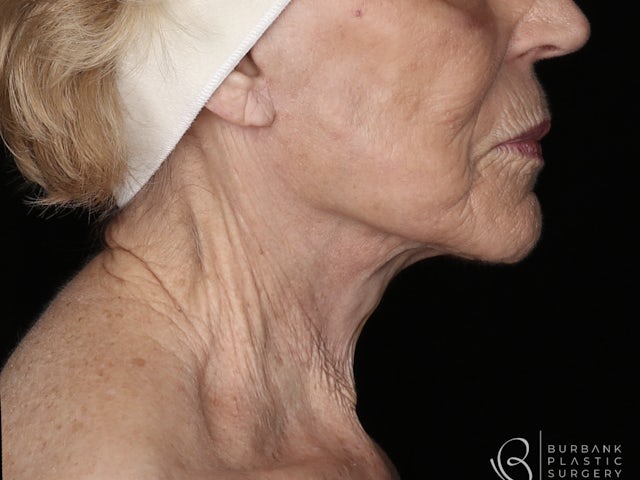 Woman's Face Post Surgery