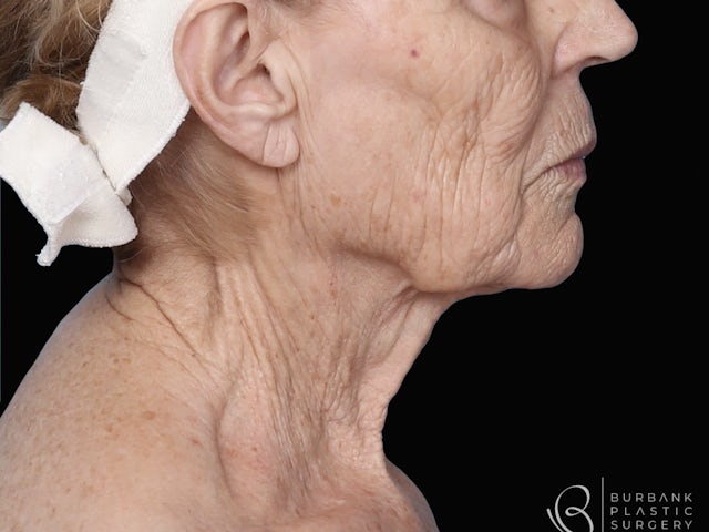 Woman's Face Before Surgery