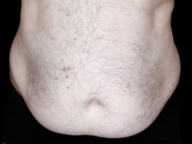 Male before abdominoplasty and liposuction