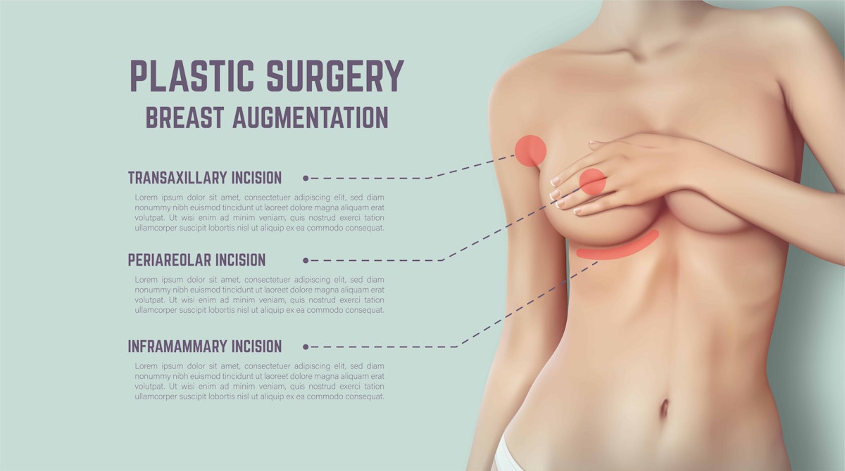 High Profile Vs Moderate Implants Selecting The Right Size
