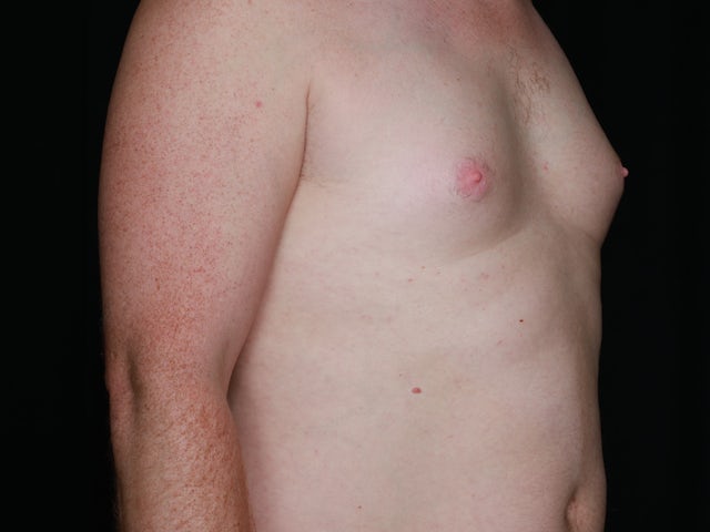 Male before gynecomastia and liposuction
