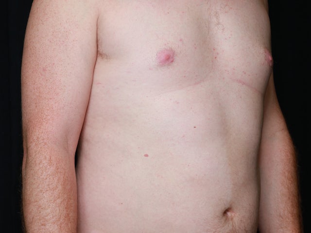 Male after gynecomastia and liposuction