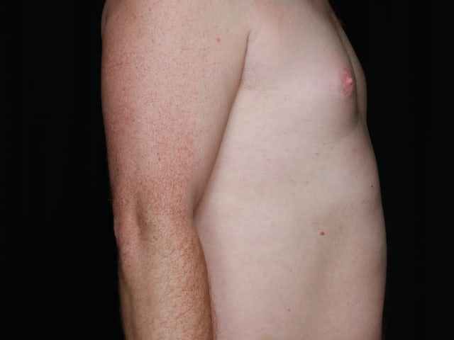 Male before gynecomastia and liposuction