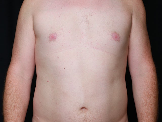 Male after gynecomastia and liposuction