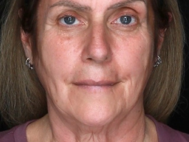 Woman before facelift and co2 laser
