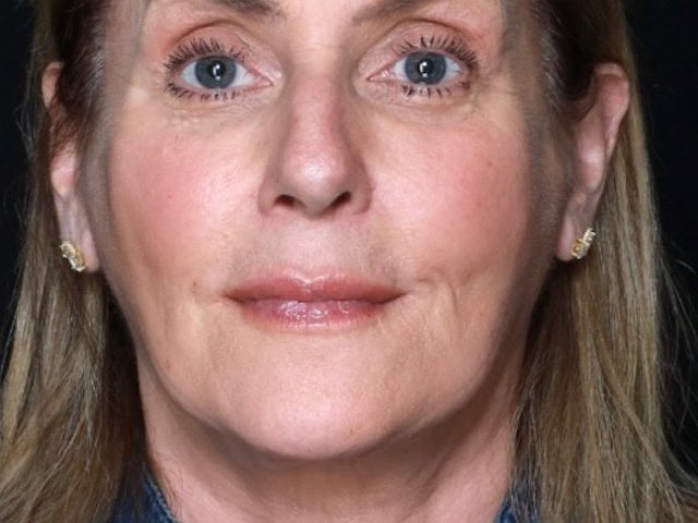 Woman after Facelift and CO2 laser