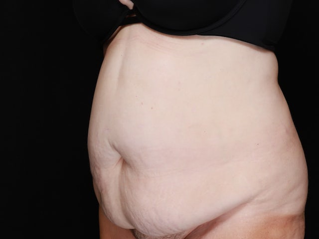Woman before tummy tuck and liposuction 