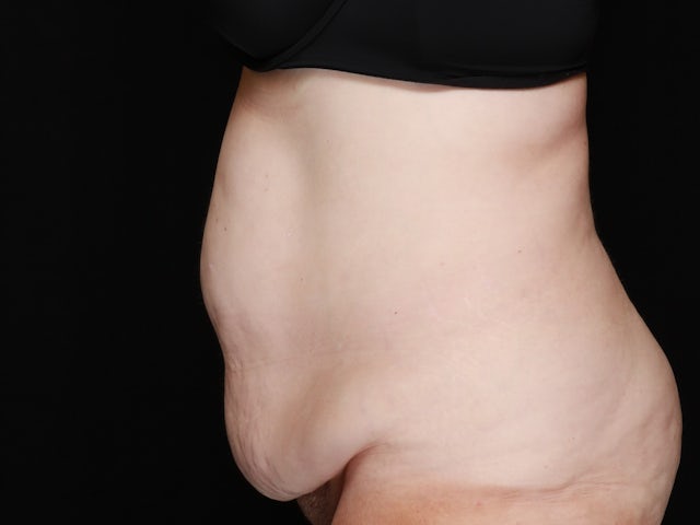 Woman before tummy tuck and liposuction 