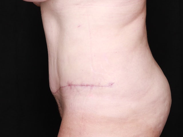 Woman after tummy tuck and liposuction