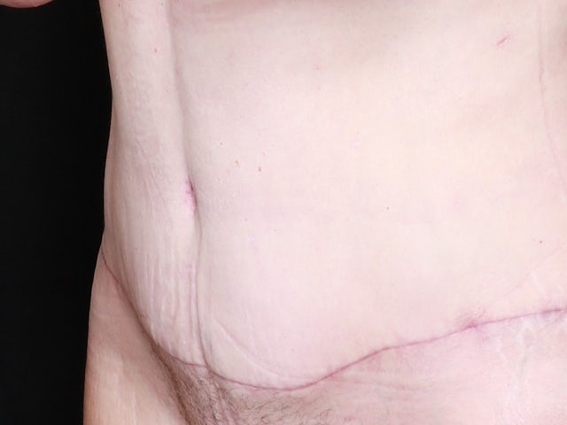 Woman after tummy tuck and liposuction