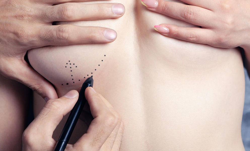 doctor draws black outline for female breast lift