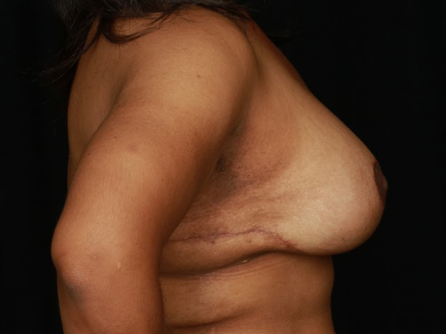 Woman after breast lift surgery
