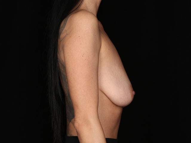 Woman before breast lift surgery