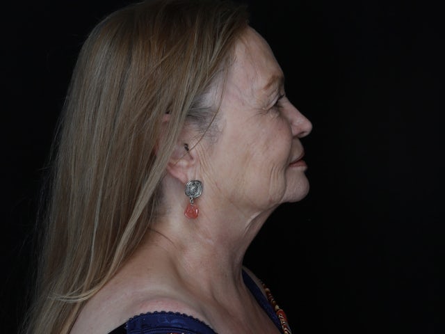 Woman before facelift