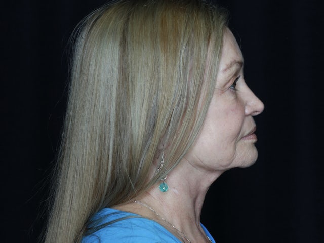 Woman after facelift