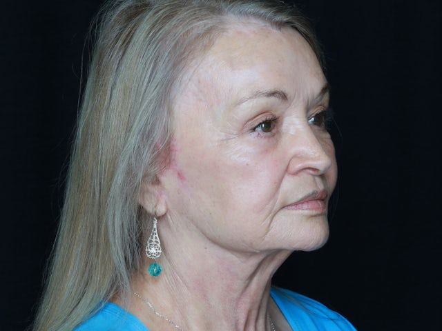 Woman after facelift