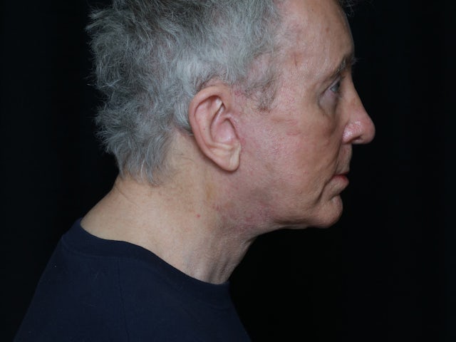 Man after neck lift and canthoplasty