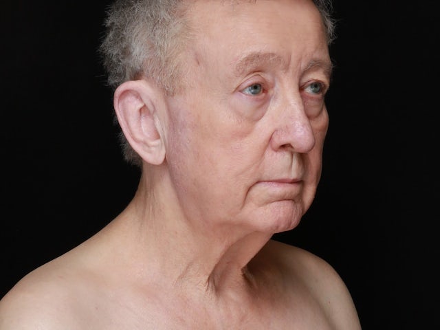 Man before neck lift and canthoplasty