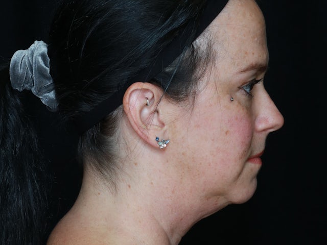 Woman before face and neck lift surgery