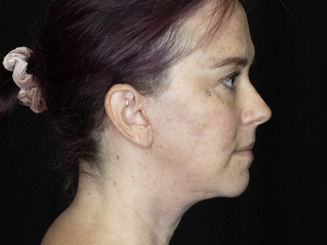 Woman after face and neck lift surgery