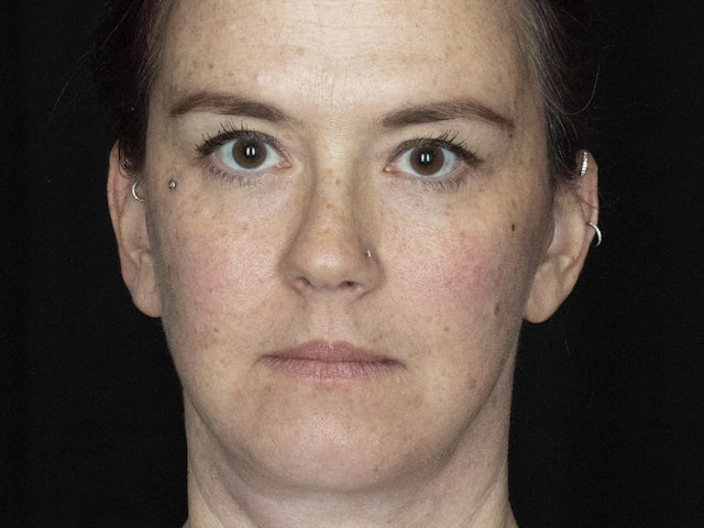 Woman after face and neck lift surgery