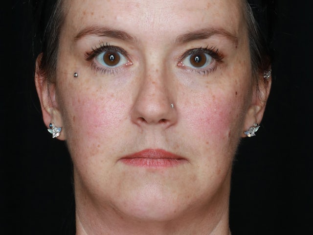 Woman before face and neck lift surgery