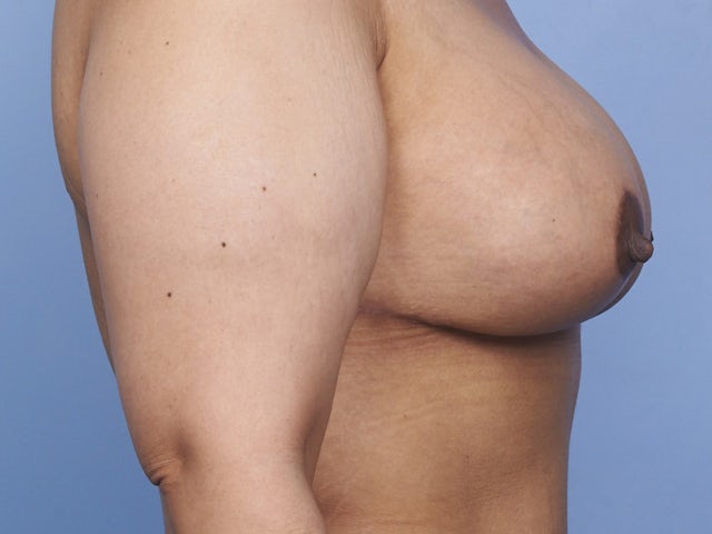 Woman after breast augmentation and lift