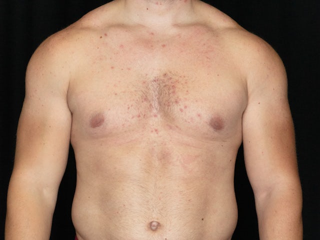 Man after gynecomastia surgery