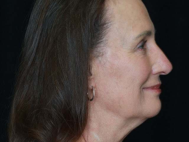 Woman before face and neck lift surgery