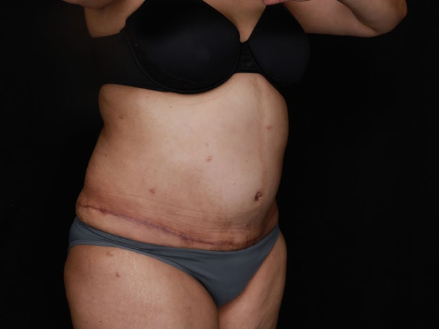 Woman after liposuction and tummy tuck