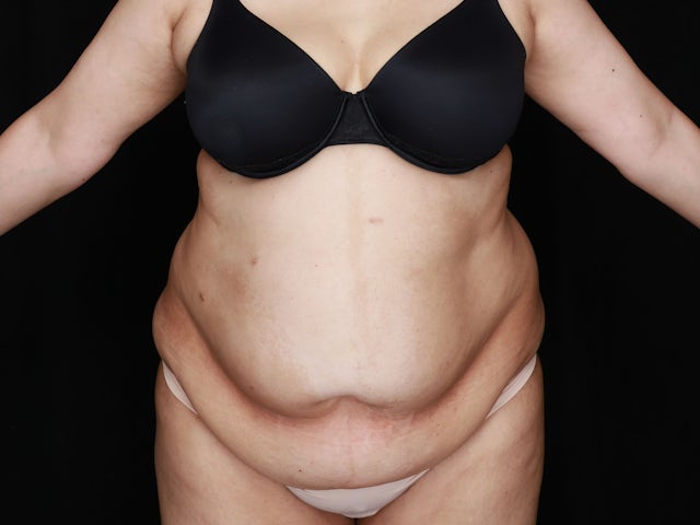 Woman before liposuction and tummy tuck