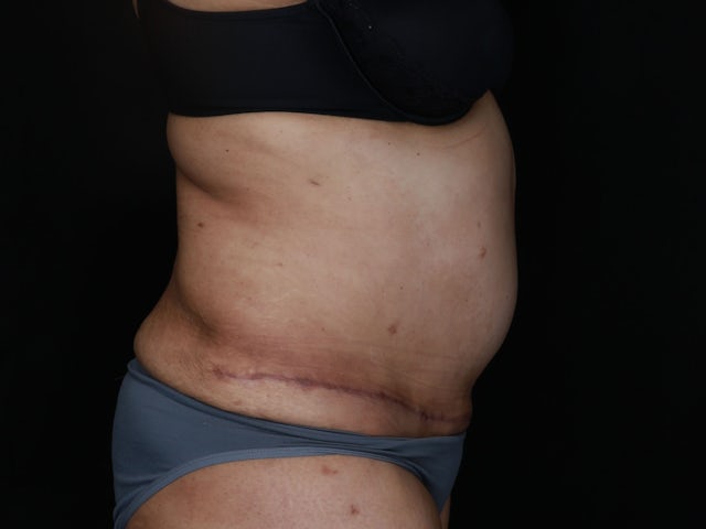 Woman after liposuction and tummy tuck
