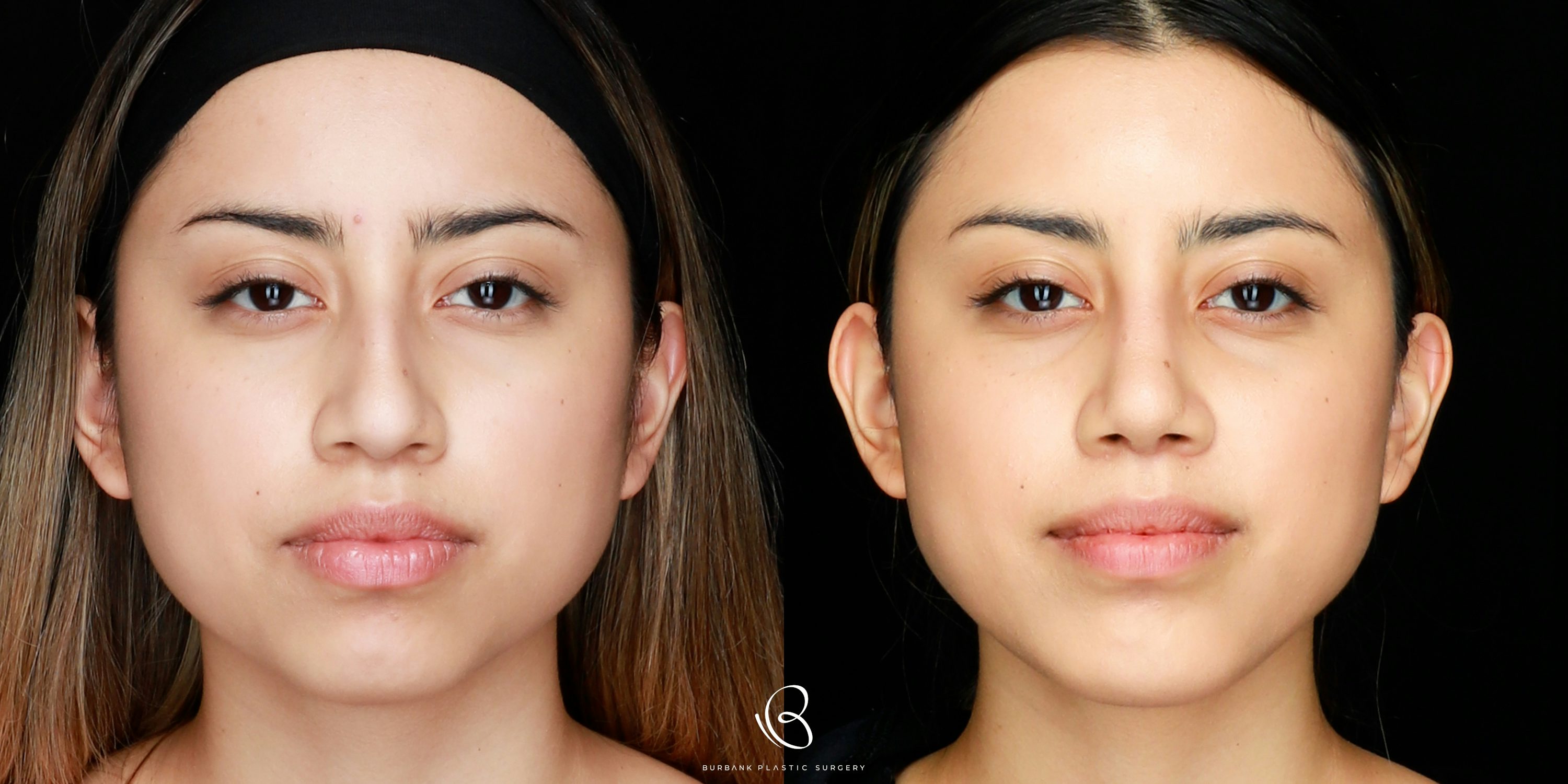 Woman Before and After Rhinoplasty Front View
